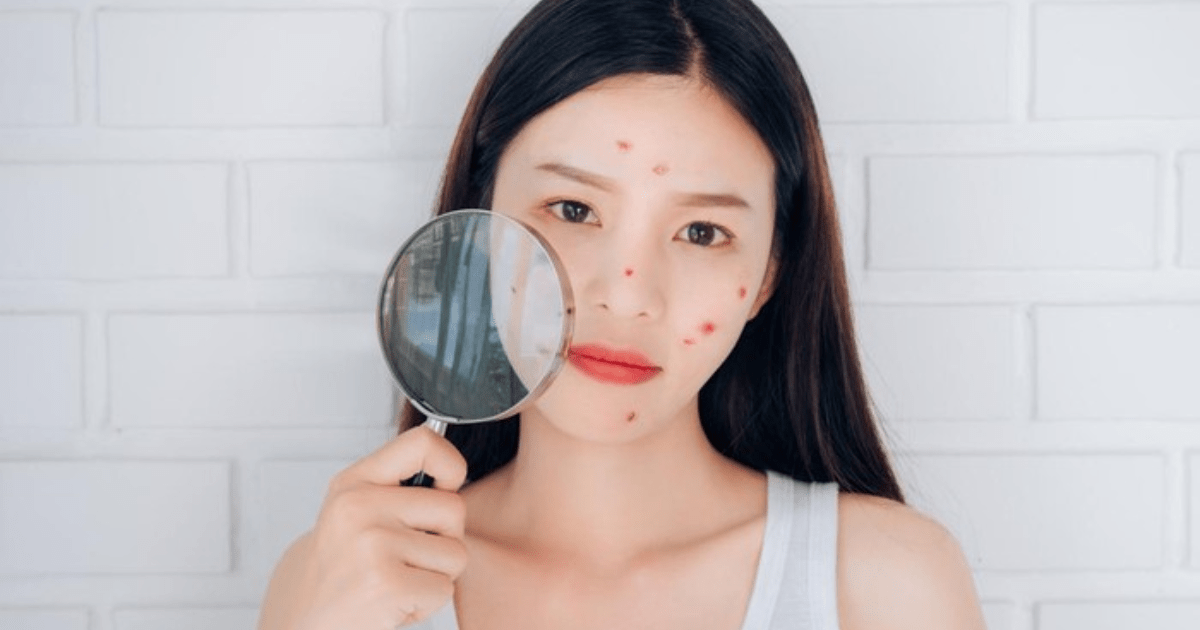 Jerawat dan Skin Barrier