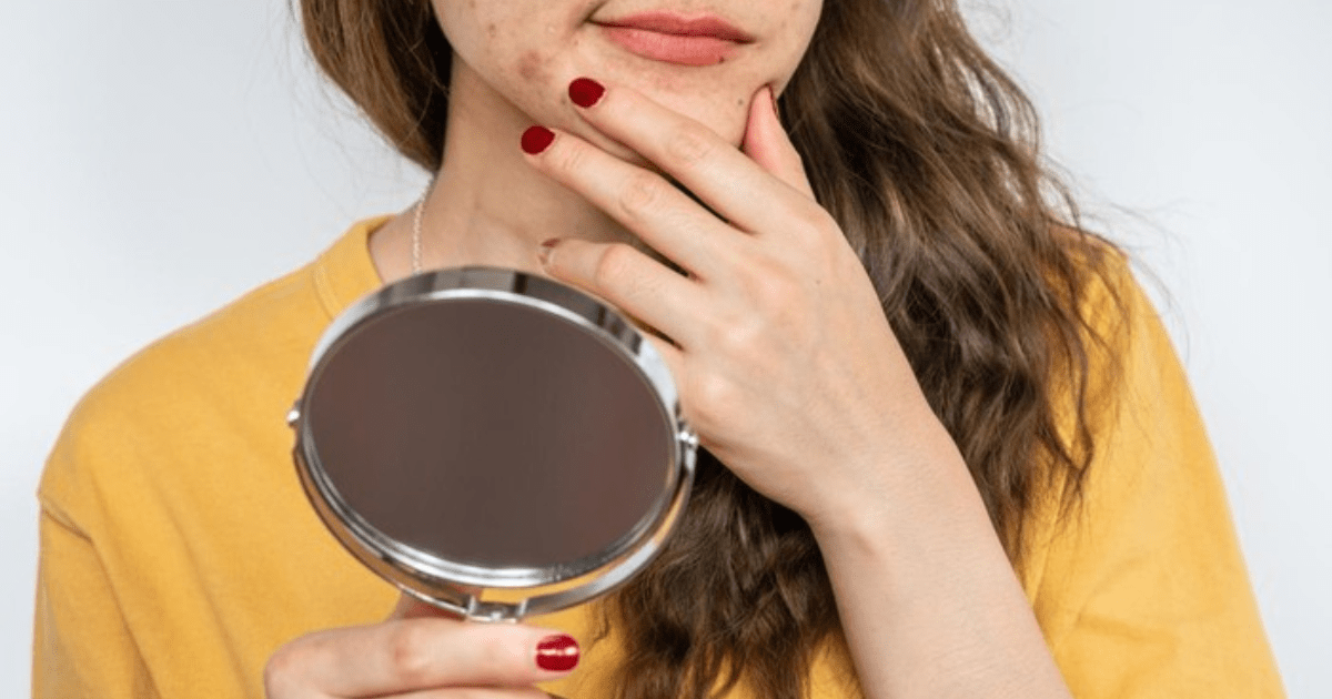 Urutan Skincare untuk Kulit Berjerawat