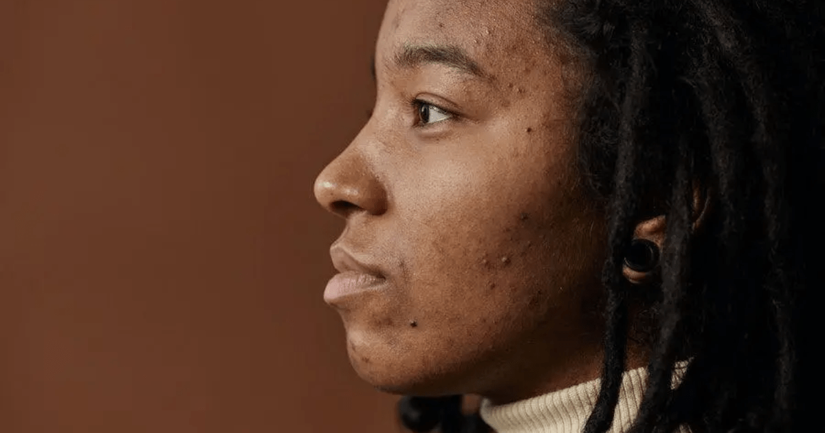 7 Cara Menghilangkan Milia di Wajah