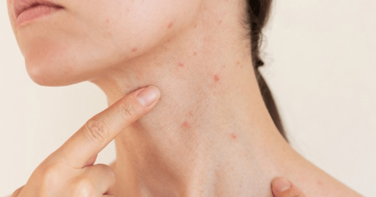 Jerawat di leher
